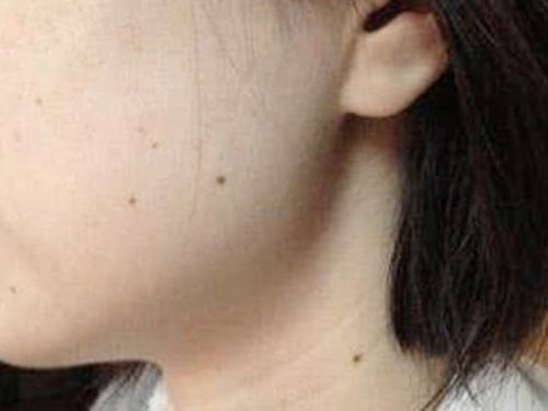 8_20191030142605218_4 臉上的黑痣是怎么形成的