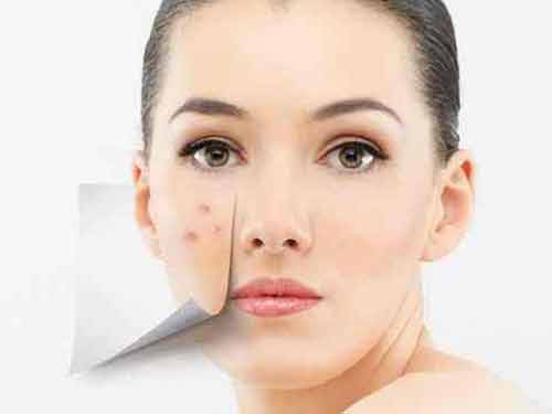 痘印痘坑怎么消除