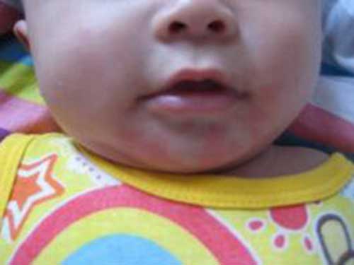 孩子皮膚過敏怎么辦