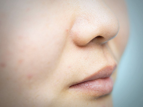 長斑的原因是怎么引起的