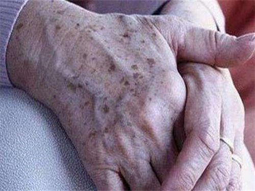 如何預防老年斑