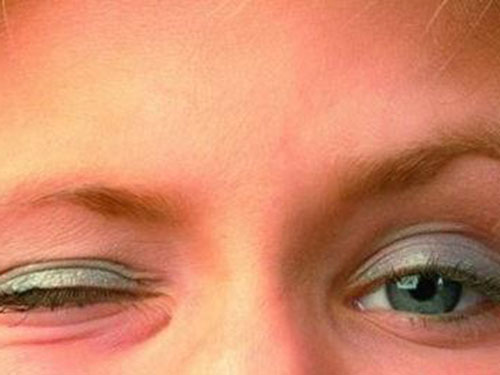 8_201958174821542_4 眼角長斑的原因