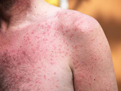 皮膚過敏該怎么辦