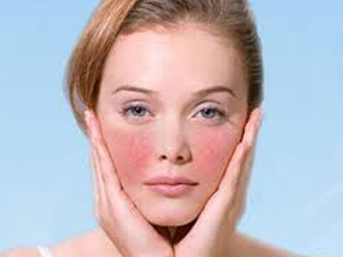 臉上為什么會有紅血絲