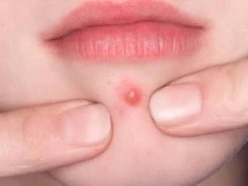 8_2019630151010764_4 怎么除去青春痘