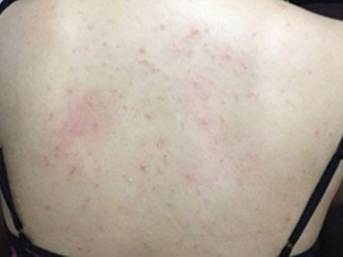 8_2019712142431218_4 背部長痘的原因