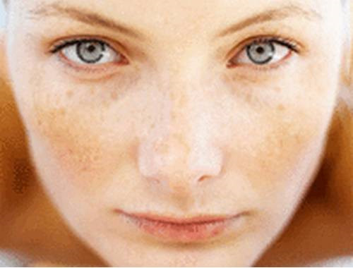 長黃褐斑是什么原因引起的