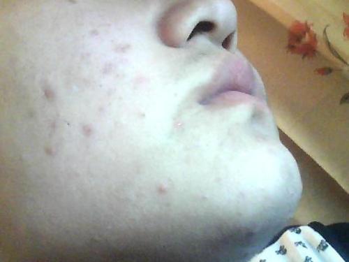 臉上暗斑如何去除