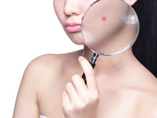 為什么鼻翼兩側長痘