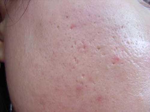 臉上的痘坑可以填平嗎