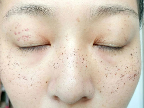 皮膚斑點是什么原因