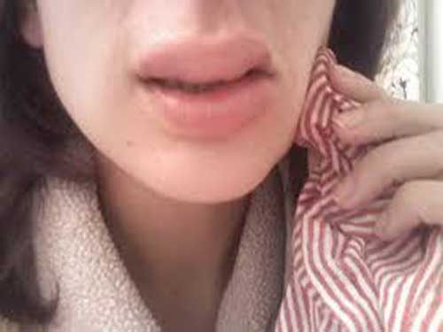 8_202031184039542_4 臉被打腫了怎么辦